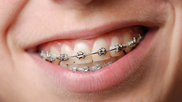 Silver Braces
