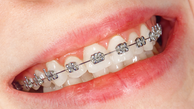 Michael-Riordan-Orthodontics-metal-braces